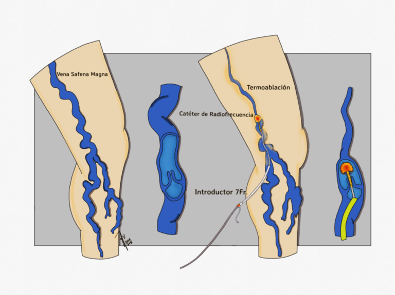 Termoablación por Radiofrecuencia de las Varices