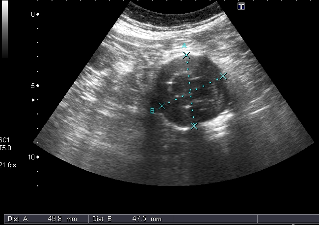 Ecodoppler de Aorta. Aneurisma de Aorta Abdominal (AAA)