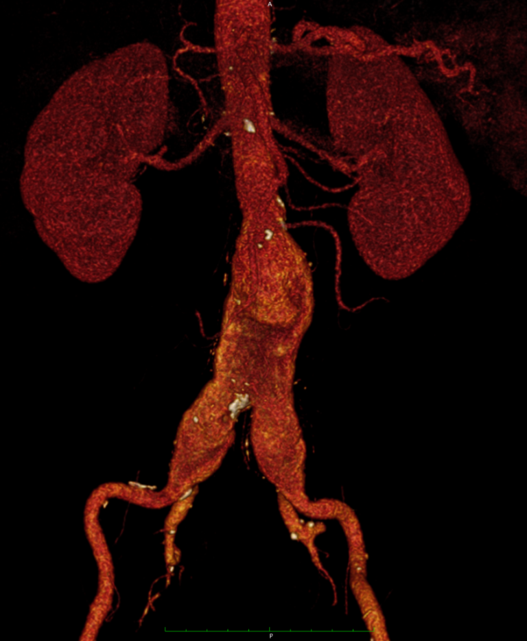 Aneurisma de Aorta Abdominal. Endoprótesis Aórtica