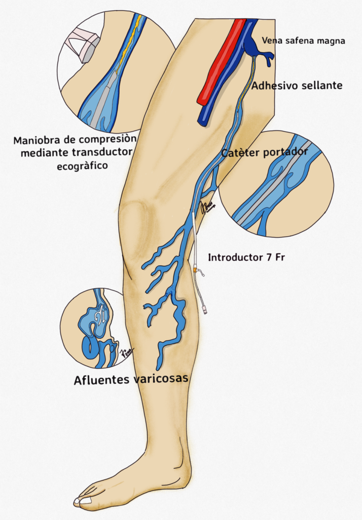 Sellado Endovenoso con Adhesivo de las Varices
