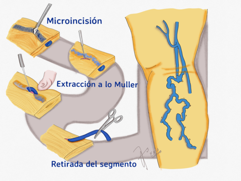 Flebectomía de Miembros Inferiores