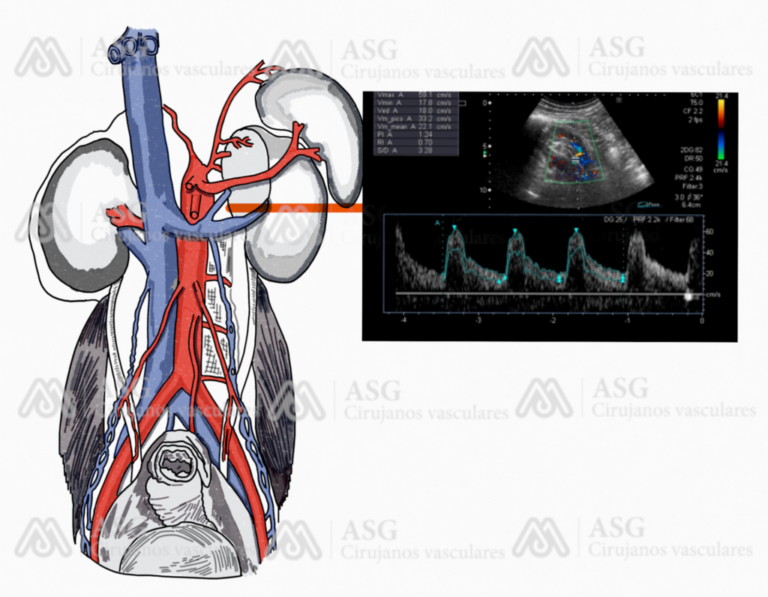 Ecodoppler de Aorta. Aneurisma de Aorta Abdominal (AAA)